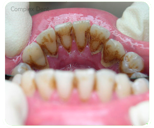 Чисті зуби не болять! - 1 | Complex Dent