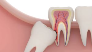 Безболезненное удаление зубного нерва | Complex Dent