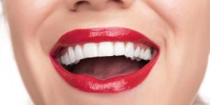 Переваги зубних вінірів - 1 | Complex Dent