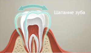 Шатание зубов — лечение и профилактика - 1 | Complex Dent