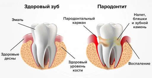 Шатание зубов — лечение и профилактика - 2 | Complex Dent