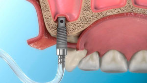 Синус - лифтинг в дентальной имплантации | Complex Dent