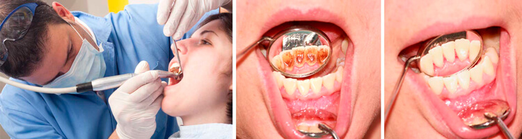 Видалення зубного каменю у стоматології - 1 | Complex Dent