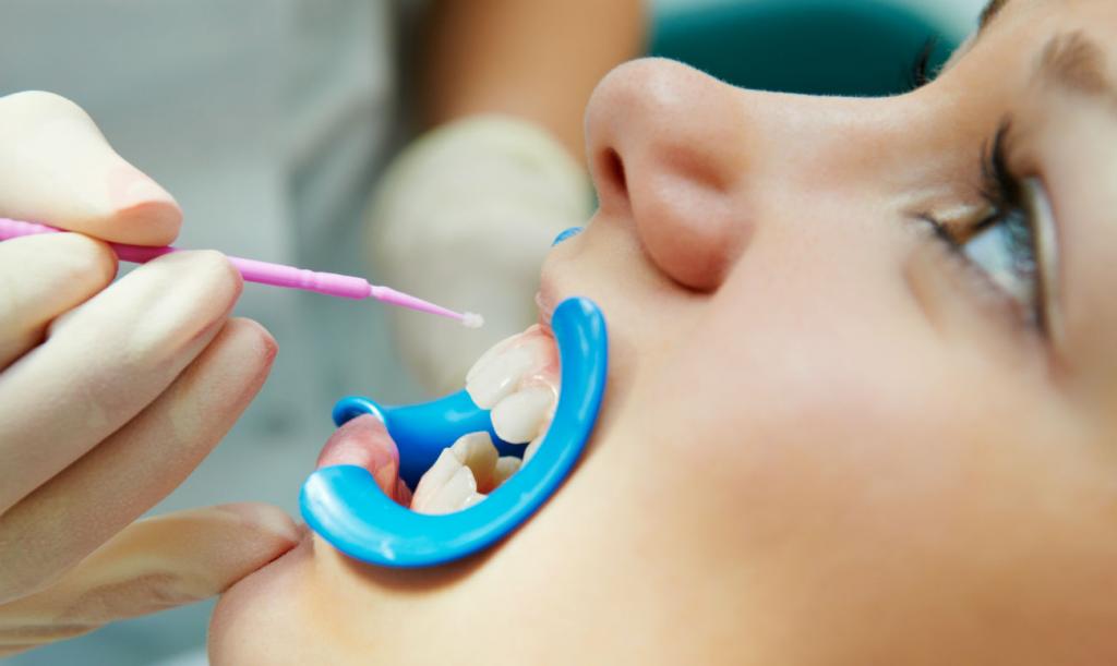 Процедура фторирования для чувствительных зубов - 1 | Complex Dent