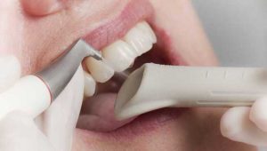 Air Flow - современная система для отбеливания и чистки зубов | Complex Dent