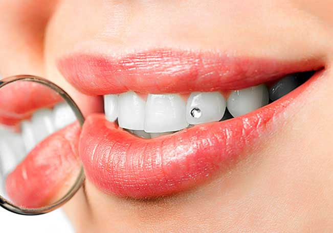 Украшения для зубов - 1 | Complex Dent