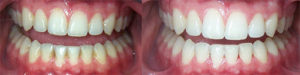 Отбеливание зубов - 1 | Complex Dent
