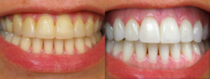 Отбеливание зубов - 2 | Complex Dent