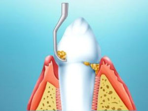 Профилактика и снятие зубного камня - 3 | Complex Dent