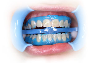 Виды отбеливания зубов: их преимущества и недостатки - 2 | Complex Dent