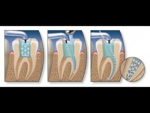 Види відбілювання зубів: їх переваги та недоліки - 3 | Complex Dent