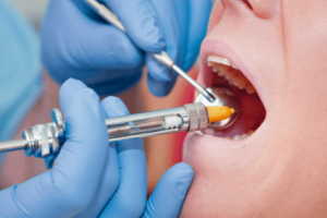Види анестезії у стоматології - 2 | Complex Dent