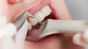 Профилактика и снятие зубного камня | Complex Dent