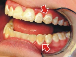 Профилактика и снятие зубного камня - 4 | Complex Dent