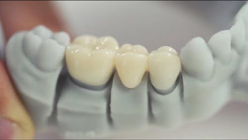 Коронки на зуби. Сучасні варіанти - 3 | Complex Dent