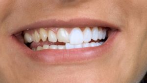 Коронки на зубы. Современные варианты | Complex Dent