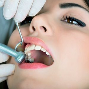 Процесс пломбирование зубов - 2 | Complex Dent