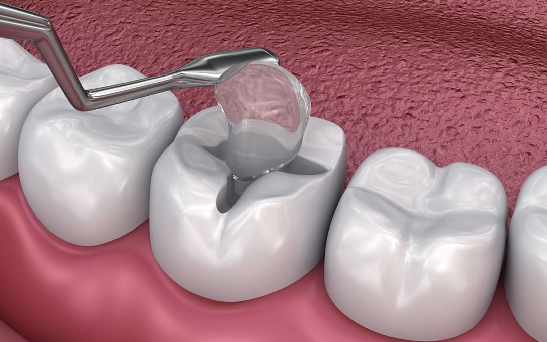 Реставрація жувальних зубів-1 | https://complex-dent.com.ua