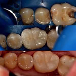 Зламався зуб — неприємний сюрприз, але не більше! - 4 | https://complex-dent.com.ua