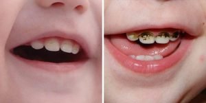 Серебрение зубов у детей - 1 | https://complex-dent.com.ua