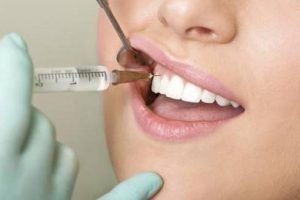 Лечение зубов с анестезией - 1 |  https://complex-dent.com.ua/