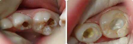 Лечение молочных зубов - 4 | https://complex-dent.com.ua