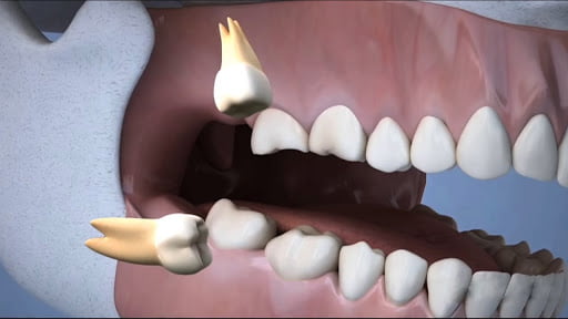 Лечение зубов - 3 | https://complex-dent.com.ua