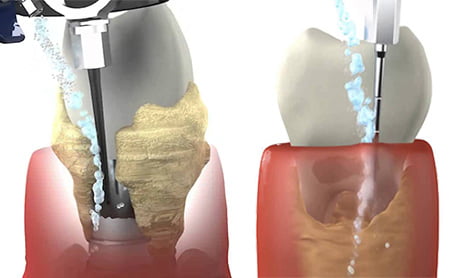 Пародонтологическая чистка зубов - 1 | https://complex-dent.com.ua