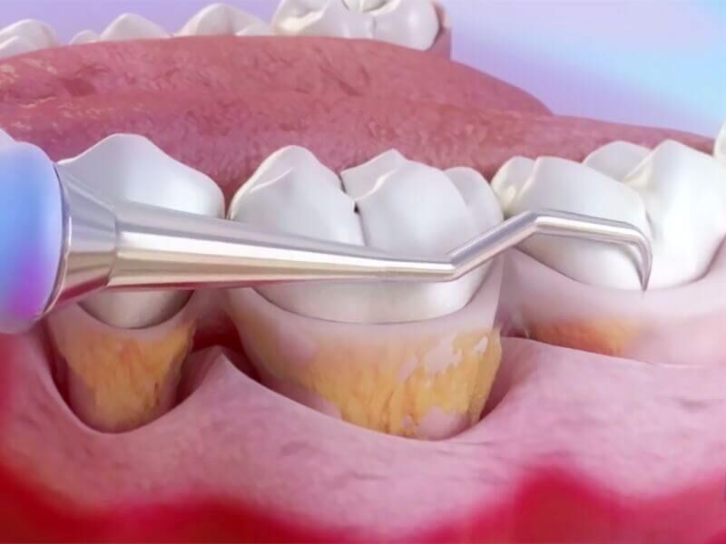 Пародонтологическая чистка зубов-1 | https://complex-dent.com.ua