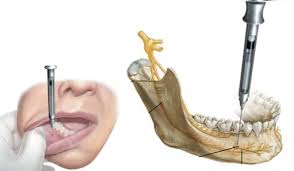 Анестезія у стоматології - 2 | https://complex-dent.com.ua/