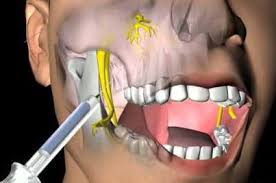 Анестезія у стоматології - 1 | https://complex-dent.com.ua/