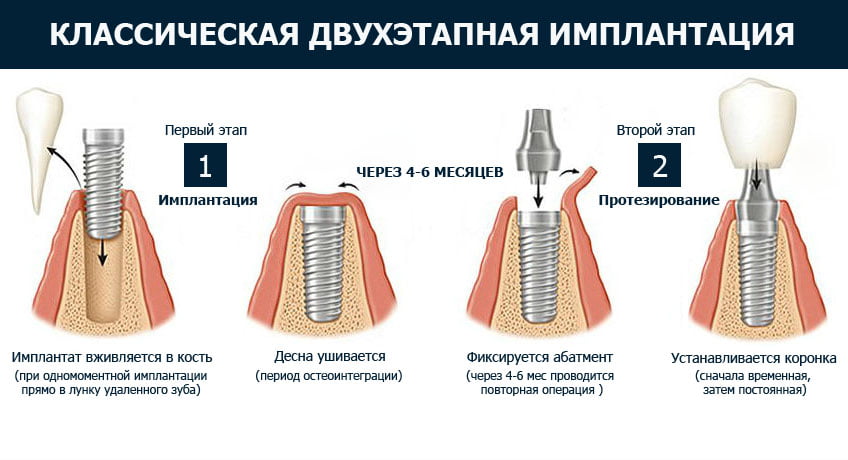 Коронки на имплантах - 3 | https://complex-dent.com.ua/