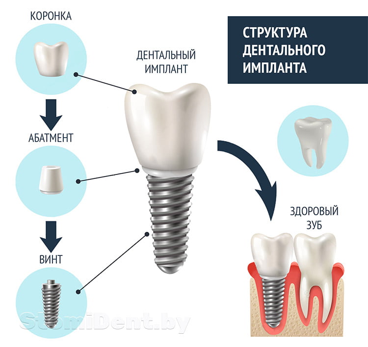 Что такое абатмент зубного импланта? - 1 | https://complex-dent.com.ua
